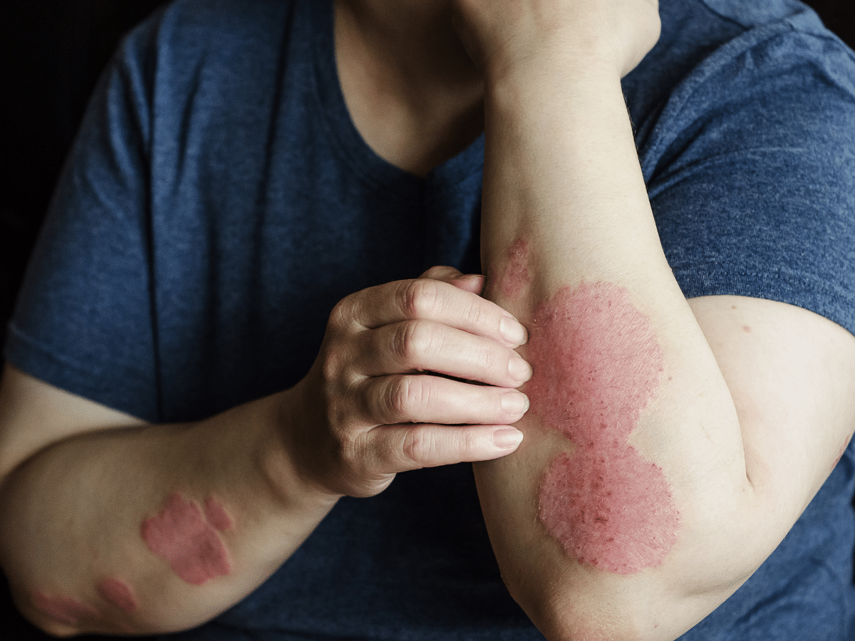 Close-up of irritated skin from eczema after shower
